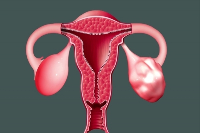 سندروم تخمدان پلی‌کیستیک و افزایش خطر ابتلا به کووید ۱۹