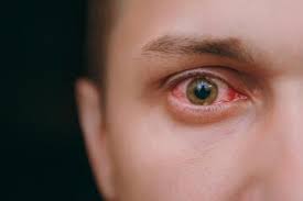 اشک چشم مبتلایان به کرونا آلوده به ویروس است